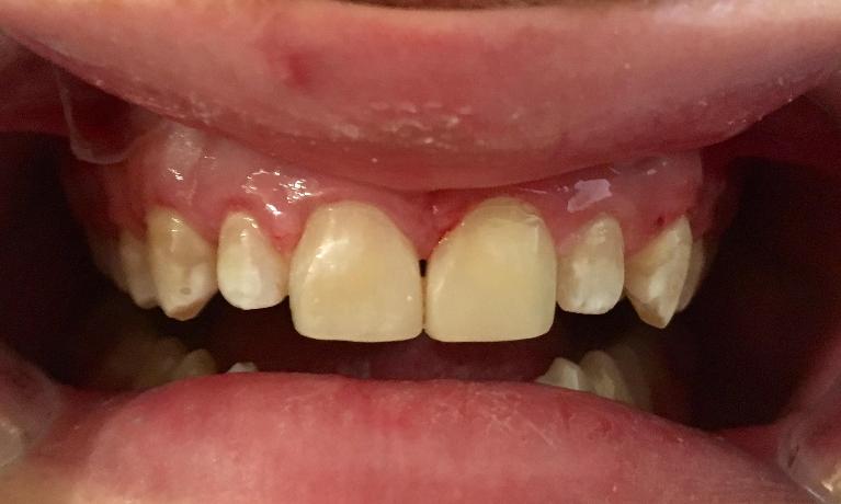 Resin-Fillings-After-Image