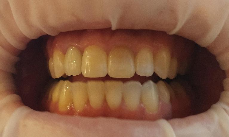 Internal-Bleaching-Before-Image