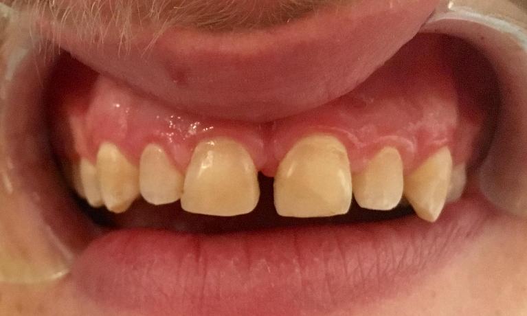 Resin-Fillings-Before-Image